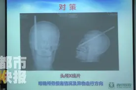 甘肃男子不慎被钢筋刺穿头部 医生取骨拔钢筋成功救治患者视频封面