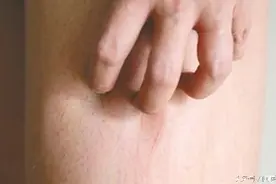 抓、挠！洗完澡皮肤痒、睡觉前奇痒无比？医生教你这样做准没错图片