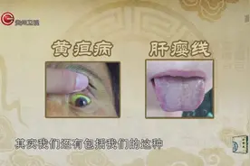 舌头如出现这样两条线一定要注意！它可能是患上肝癌的提前预警视频封面