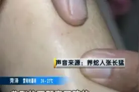 菏泽：七岁女孩被毒蛇咬伤！图片