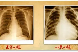 我们身体里有只“蝴蝶”，它过于活跃，或者“偷懒”对心脏很危险图片