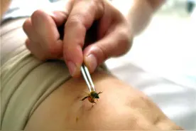 用蜜蜂蜇人治病？穴位针灸埋蛋白质线减肥图片