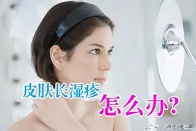 湿疹该怎么忌口？图片