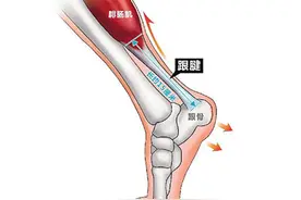 运动损伤——Uncle36告诉你跟腱断裂（一）图片