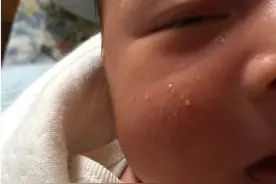 宝宝脸上有小米粒似的东西检查是湿疹，治疗及预防宝宝湿疹的方法图片