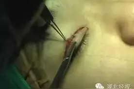 吓尿！女大学生做双眼皮手术，术后眼睛闭不拢，还有更恐怖的！图片