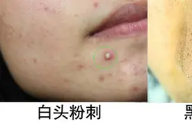 粉刺是如何形成的？图片