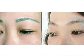 激光洗眉后眉毛还能生长吗图片