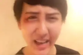 蛇精男刘梓晨被打的鼻青脸肿假体都歪了 网友：我要给英雄送锦旗图片