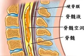 脊髓空洞症患者康复中应该这样做!图片