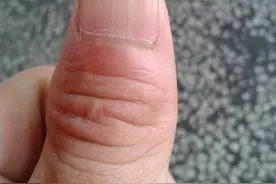 指甲的小月痕——身体健康晴雨表图片