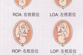 给你全面了解胎位知识，帮助选择分娩方式（上篇）图片