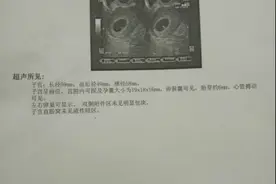 孕6周看不到孕囊急哭了 这样胞胎终于等来了胎心图片