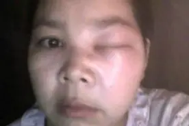 被马蜂蜇了用清凉油能解毒这是真的吗？还有什么更加有效的办法吗视频封面