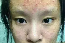 美容专家支招：2个月祛除痘痘，重现婴儿肌图片