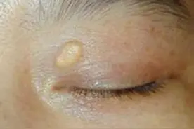 眼皮上的小肉粒隐藏健康秘密，老中医一眼看出来！图片