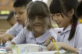 六个子女，3个得了狼人症，一辈子有理不完的毛发图片
