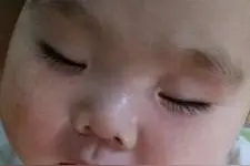 宝宝得奶癣是怎么回事 该如何有效防治奶癣？图片