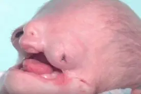 女宝宝出生后脸部畸形，耳朵全聋只一眼能看，但却常面带笑容图片
