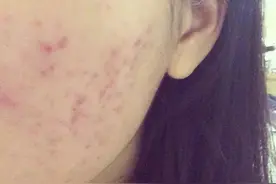 青春痘并不仅仅是青少年的专利，80后也一样会有青春痘图片