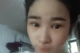 全切双眼皮20多天，老公说至少年轻了10岁，开心！图片
