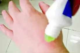 女子大腿严重溃烂惨不忍睹，只因为被它咬了一口！图片