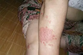 妈妈在哺乳期有了股癣，怎么有效根除治疗？图片