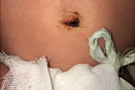 育儿爸妈必看！宝宝出生四周脐炎去世！新生儿护理不是你想的那么简单！图片