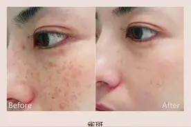 治疗雀斑为什么有的人一次恢复不反弹，有的人几次治疗都反弹图片