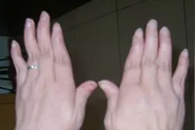 如何分辨多肌炎和皮肌炎？图片
