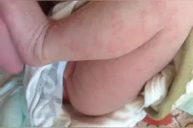 育儿知识   婴儿湿疹最佳治疗方法图片