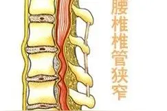 关于腰椎管狭窄怎么样治疗的措施有几种图片