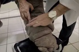 巴西男子长出“大象腿”，左腿肿胀皮肤灰色丧失劳动能力图片