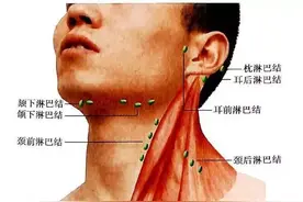 不好，我脖子长了淋巴结！摸到淋巴结时该怎么办？图片