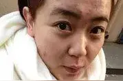 常年长痘怎么办？教你祛痘不留痕！图片