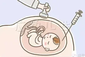 羊水穿刺到底安全吗？图片