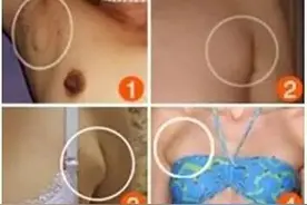 听说刮痧可以除副乳！二胎妈妈为何泣不成声？图片