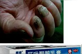 脚气，灰指甲--真菌感染用药，别被高价药忽悠了图片