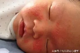 宝宝长了湿疹瘙痒难受，宝妈应该这么做图片