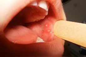 孩子嘴里长了一些透明的小泡泡，还很疼，那是什么？图片