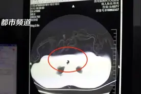 咳嗽吐血十多天 原来是蚂蟥作祟！视频封面