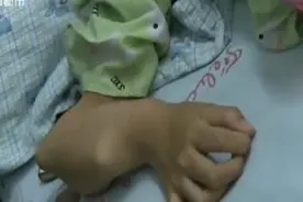 12岁女孩患奇病 右臂弯曲似“镰刀”！视频封面