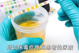 尿毒症多半是拖出来，医生提醒：糖友身上2处发臭，别忽视视频封面