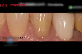 牙龈楔状缺损修复视频封面