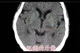 脑卒中之基底节腔隙性脑梗塞，老年人常见，基底节解剖-全是干货视频封面