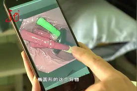 男孩常喊肚子疼 到医院一检查 发现胃里有八个磁棒一个磁球视频封面