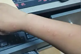 又被咬了，有什么止痒小妙招？图片
