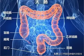 一文读懂：结肠癌的早中晚期与对应的治疗方法和预后图片