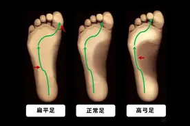 什么是高弓足？高弓足的症状和危害有哪些？图片