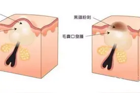 扫盲:闭口粉刺的前世今生以及解决方法图片